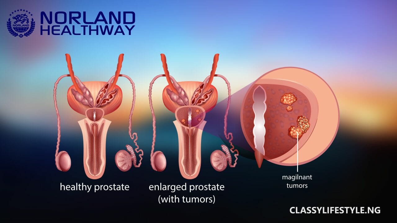 NORLAND PRODUCT FOR PROSTATE 2021 Classy Lifestyle