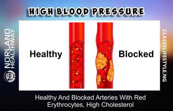 Norland Product For High Blood Pressure, Healthy and Blocked arteries with red erythrocytes, high cholesterol