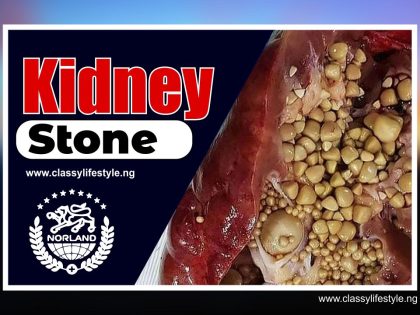 Norland Product Saved Me From Kidney Stone